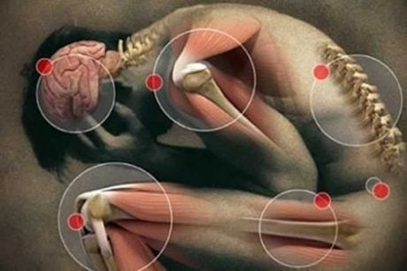 Fibromialgia: o que você precisa saber?